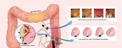 Colon Sparing Endoscopic Full-Thickness Resection for Advanced Colorectal Lesions: Is It Time for Global Adoption?